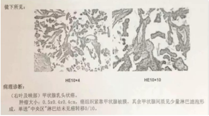別慌，甲狀腺疾病還可以這樣投保！